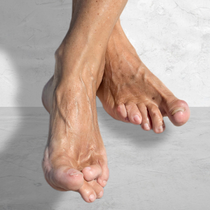 Arthritic Foot Conditions - Soleil Surgical