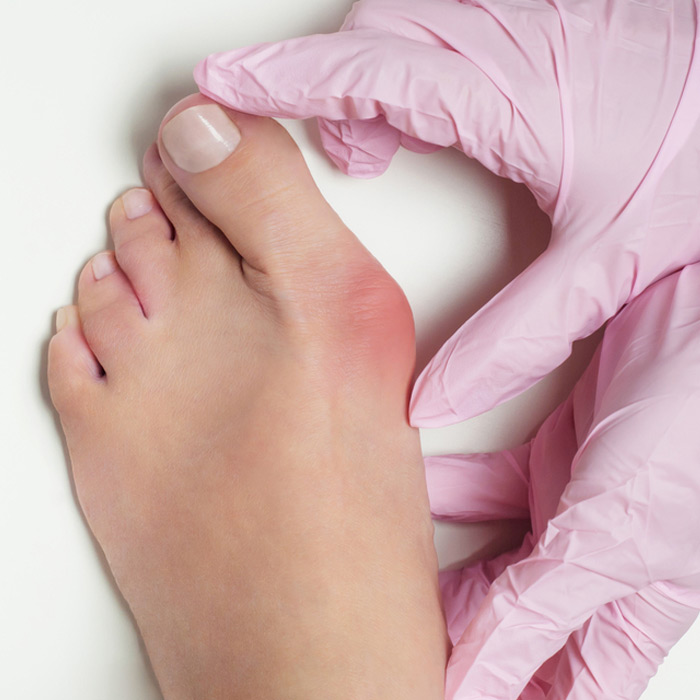 Bunions - Soleil Surgical