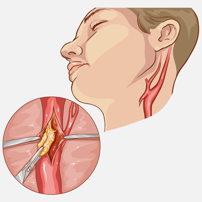 Abdominal Aortic Aneurysm - Soleil Surgical
