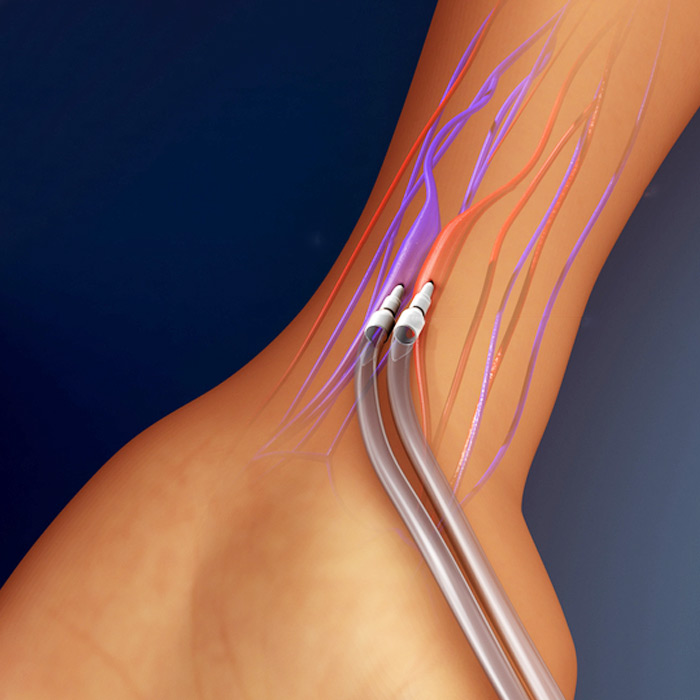 Carotid Artery Disease - Soleil Surgical