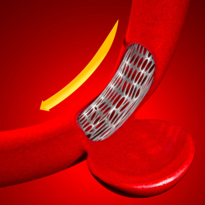 Deep Vein Thrombosis - Soleil Surgical
