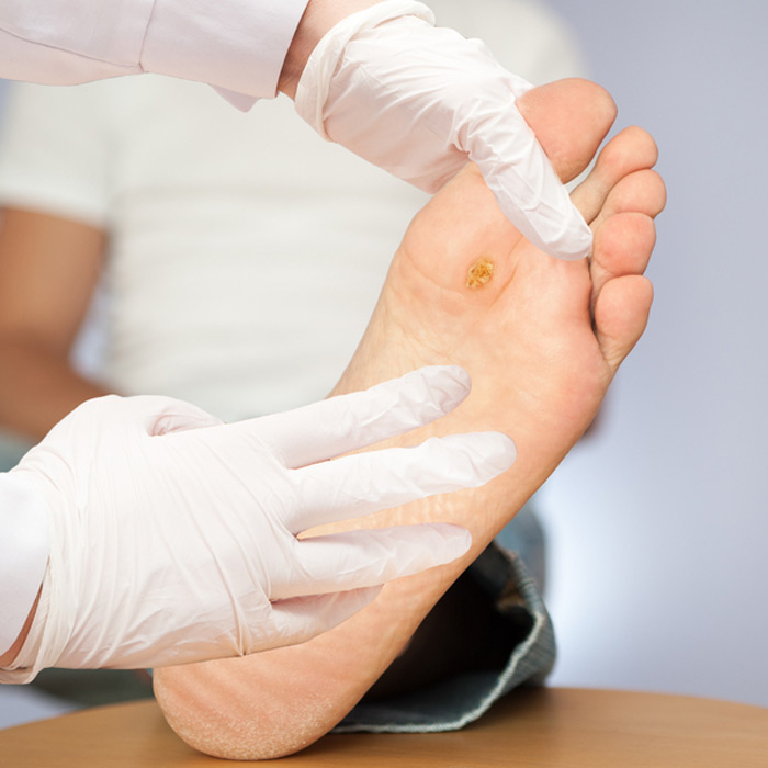 Foot Ulcers / Sores - Soleil Surgical