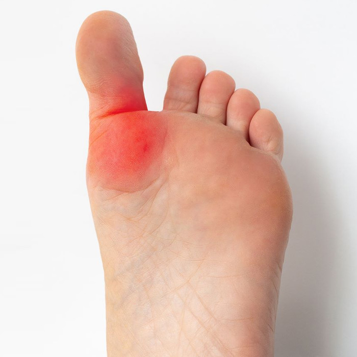 Hallux Rigidus - Soleil Surgical