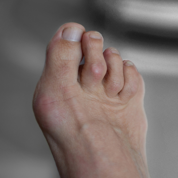 Hammertoe - Soleil Surgical
