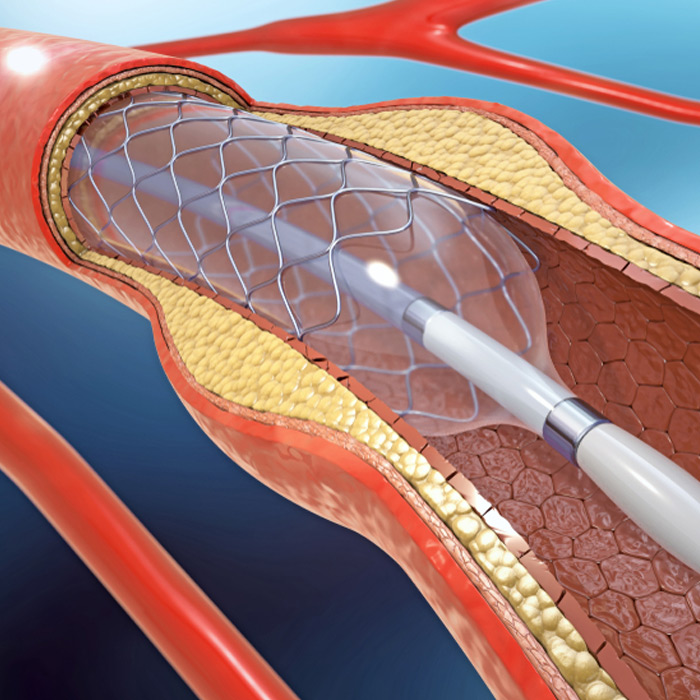 Peripheral Aneurysm - Soleil Surgical