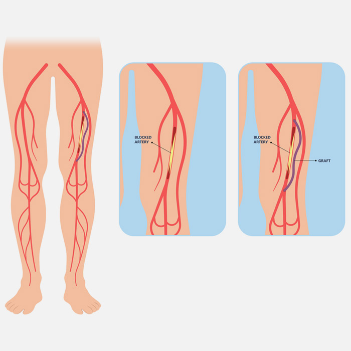 Mesenteric Ischemia - Soleil Surgical
