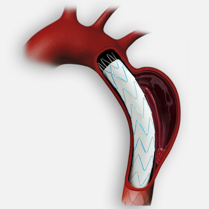 Peripheral Arterial Disease - Soleil Surgical