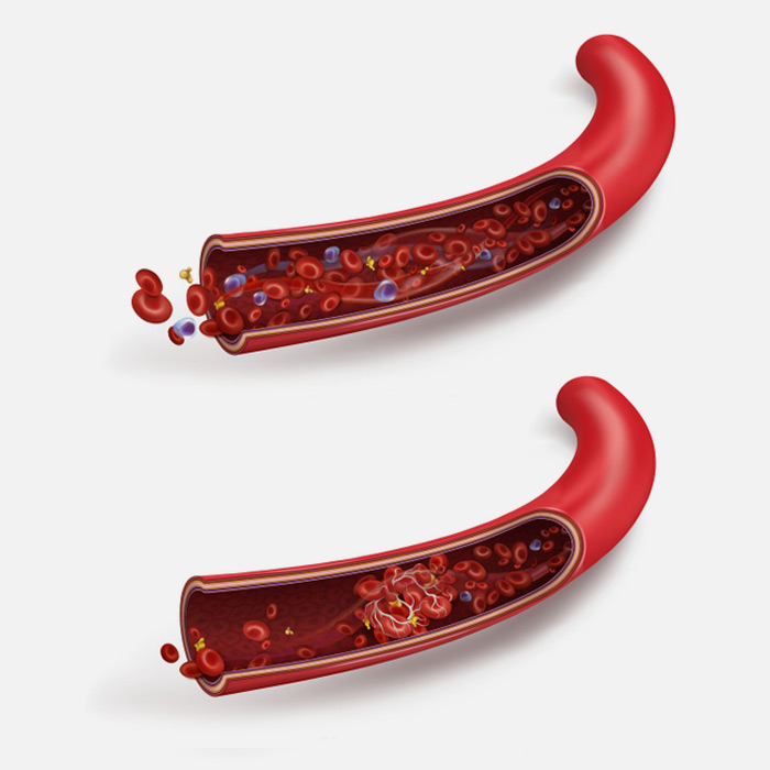 Portal Hypertension - Soleil Surgical