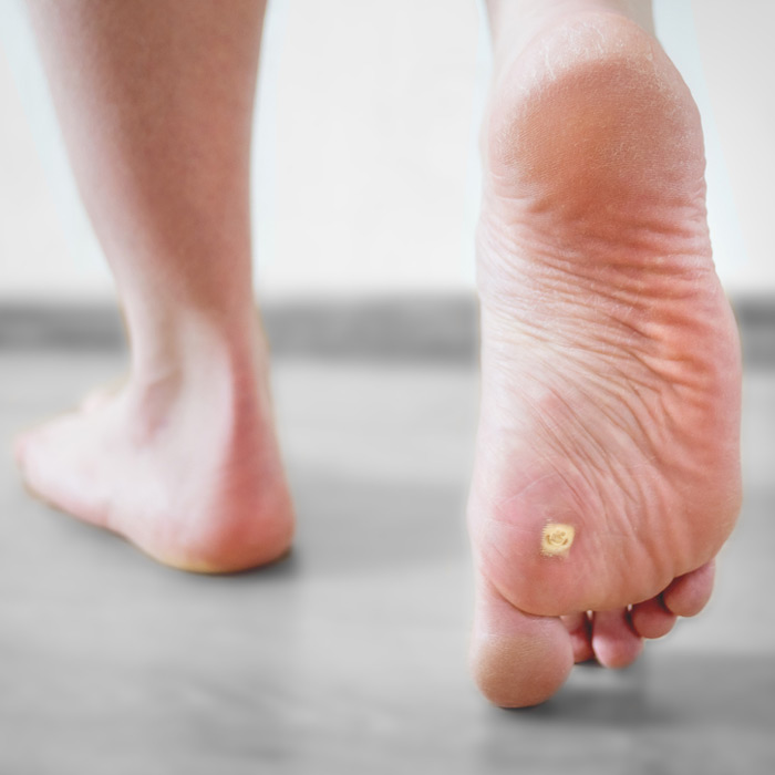 Warts - Soleil Surgical