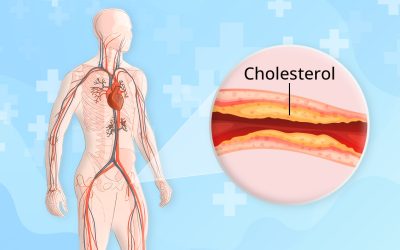 From Symptoms to Solutions: Navigating Peripheral Arterial Disease