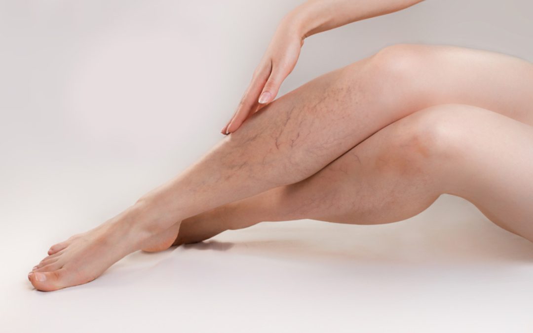 Varicose Veins and How to Treat Them