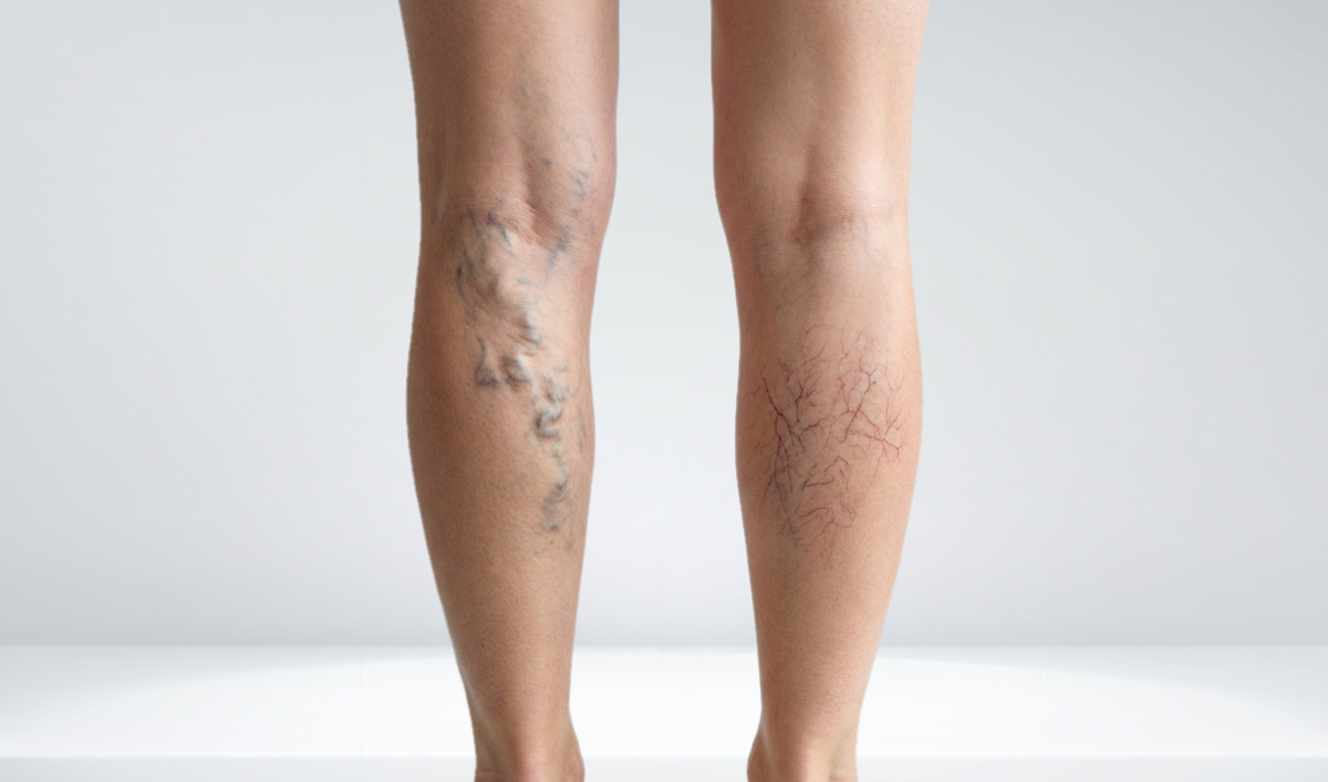 Varicose veins and spider veins happen when the valves in your veins aren’t working properly .