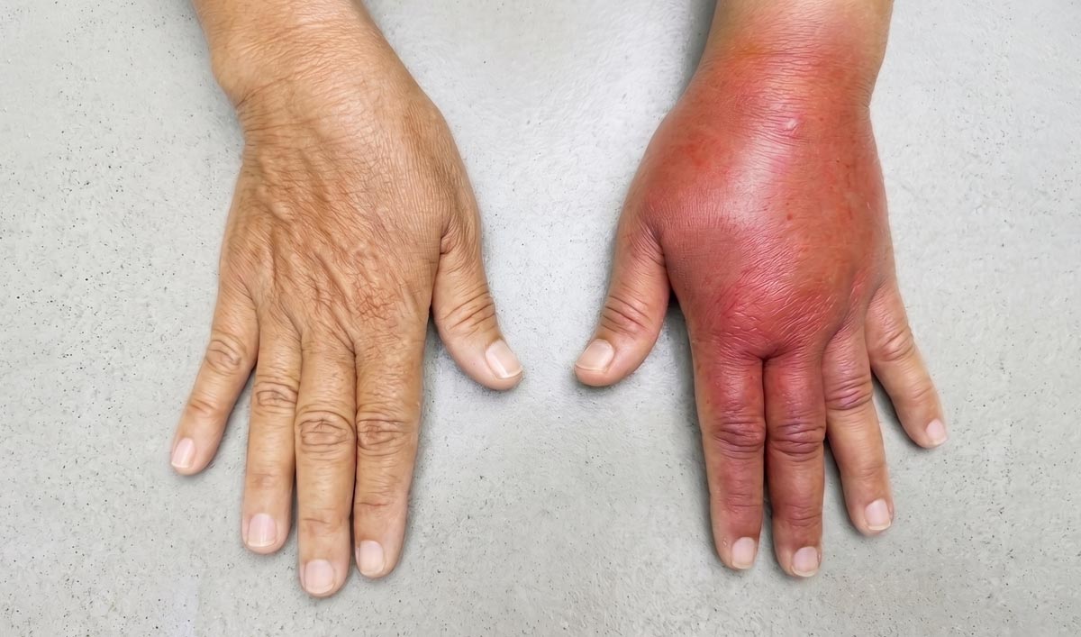 4 Early Warning Signs of Lymphedema