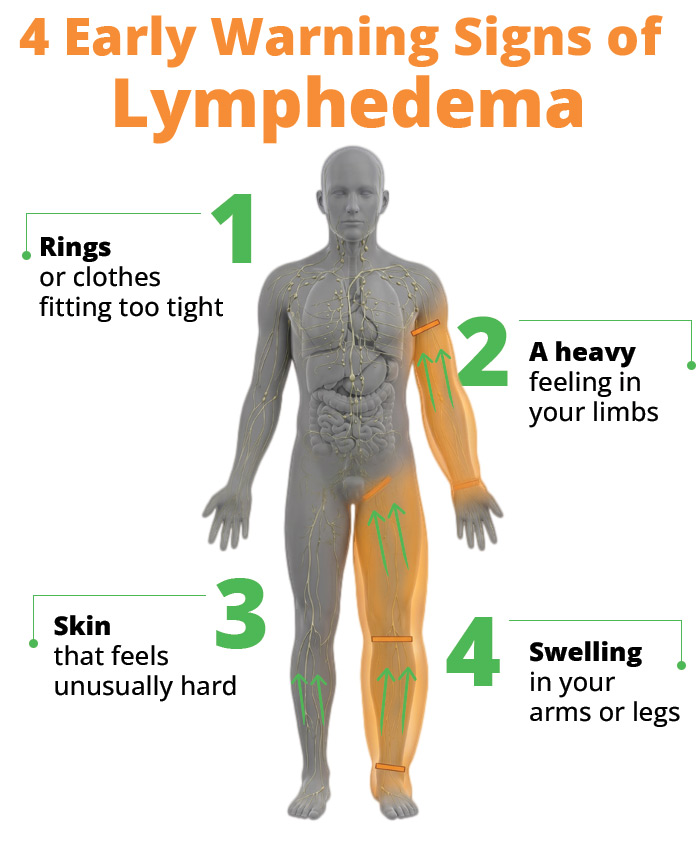4 Early Warning Signs of Lymphedema